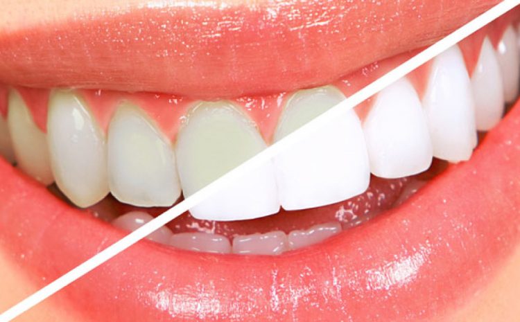  Blanqueamiento dental, ¿en qué consiste esta técnica?