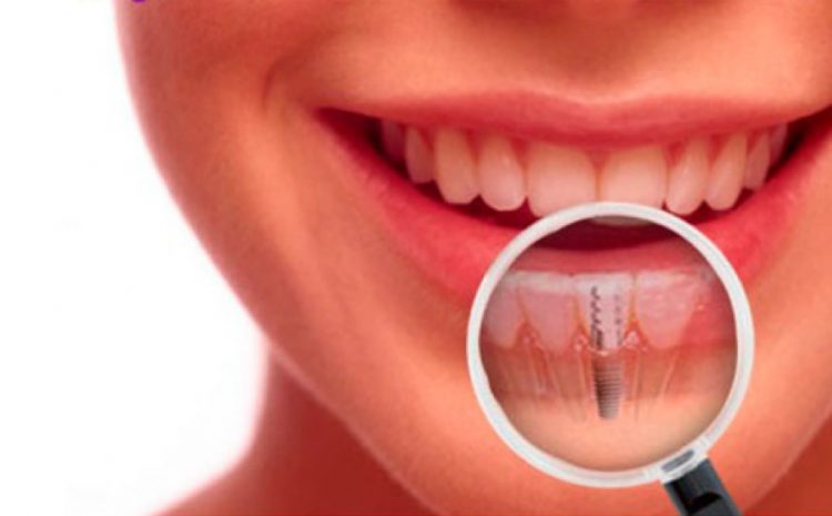  Implantes dentales = calidad de vida